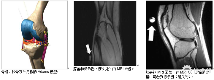 案例分析：密苏里大学-Adams 仿真帮助诊断膝盖病的图2